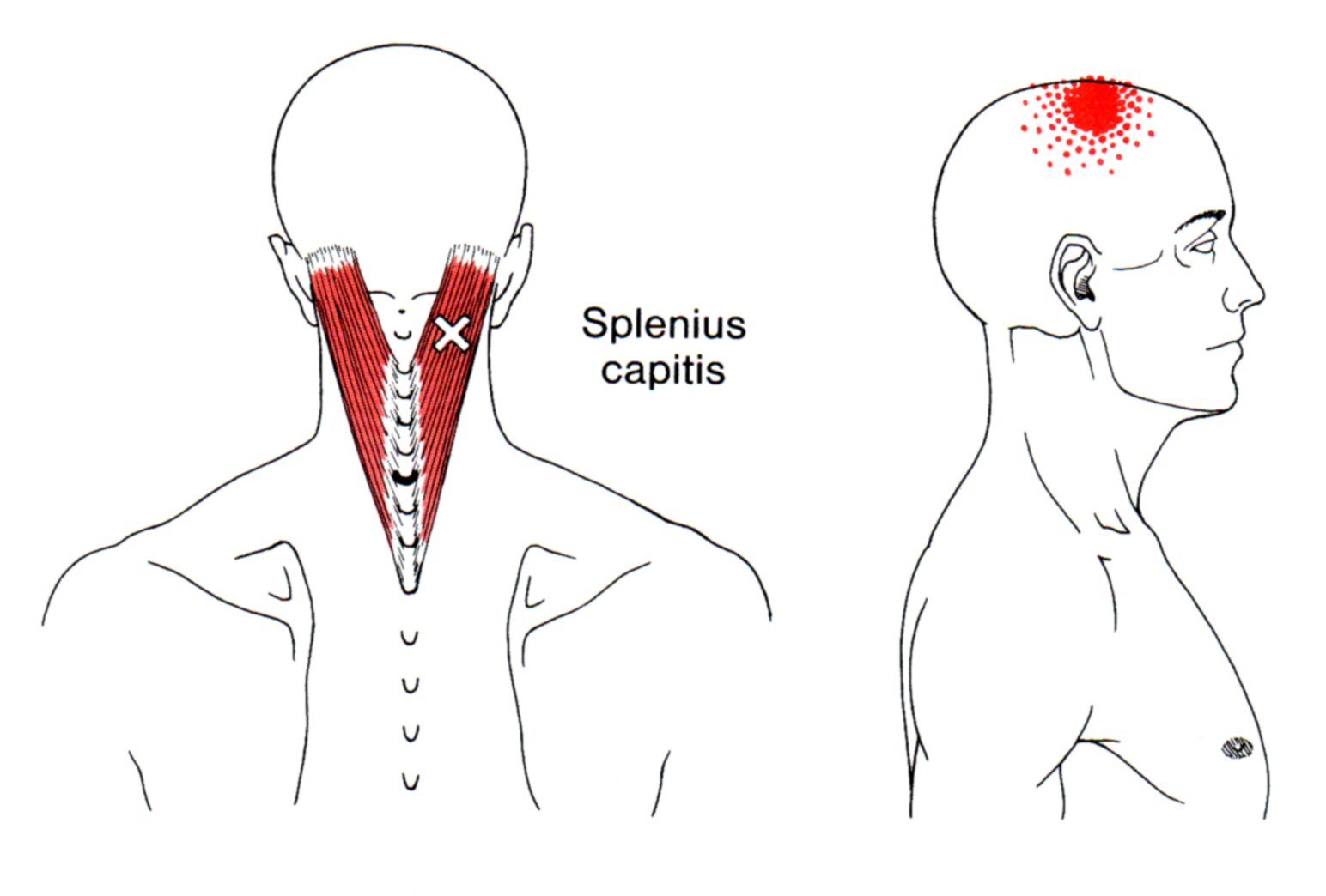 Splenius Capitis The Trigger Point & Referred Pain Guide